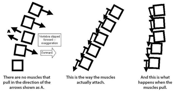 Fibromyalgia | Scoliosis | Multiple Sclerosis
